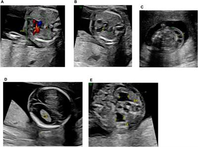 Prenatal diagnosis of dicentric chromosome X mosaicism: a case report and review